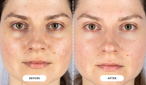 LED Face Mask Before and After: Experience Skin Transformation with the LED Face and Neck Mask