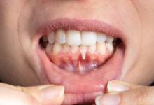 Why Receding Gums Can Change The Way Teeth Respond To Temperature