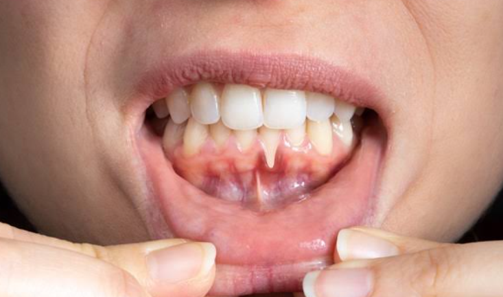 Why Receding Gums Can Change The Way Teeth Respond To Temperature