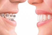 The Connection Between Orthodontics And Jaw Alignment