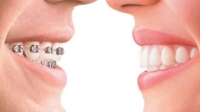 The Connection Between Orthodontics And Jaw Alignment